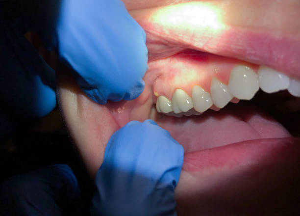 Best Emergency Wisdom Teeth Removal in Sherwood Manor, CT